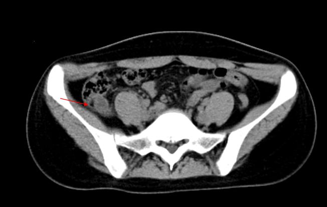急诊科常见急腹症观察,腹部急诊影像大全值得收藏