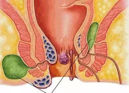 中医都有哪些药治疗肛周脓肿的,倪海厦讲中药治肛周脓肿