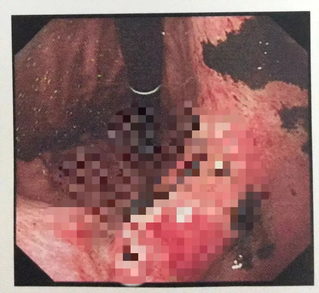 发现男友与前任联系，女子连吃5大包辣条，结果……