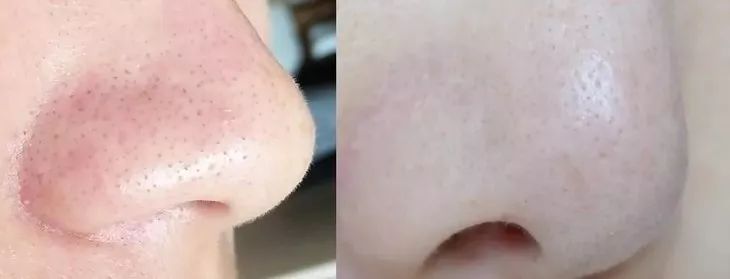 拨黑头工具草莓鼻,去黑头神器真的能吸出黑头