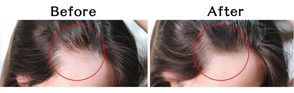 拯救秃头黑科技,秃头女孩最快的拯救办法是什么