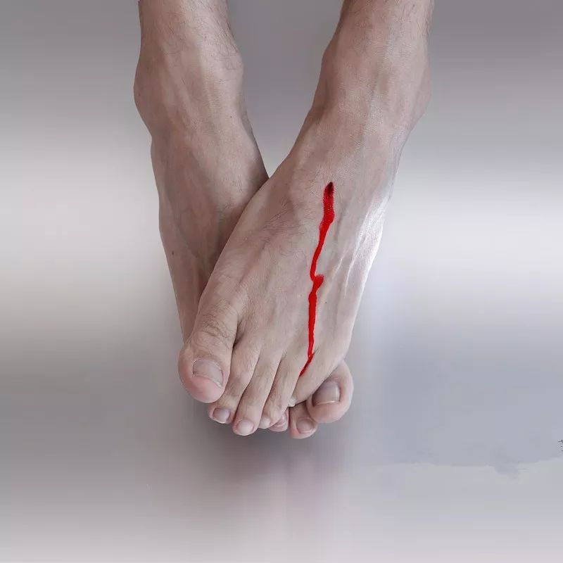 恐怖！穿双新鞋去踏青，几天后脚趾溃烂，差点要截肢！原因竟是...