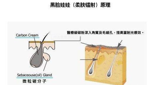 常见的美容激光项目,脉冲激光治疗后的注意事项