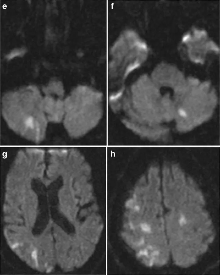 如何平稳度过脑水肿,多种原因导致的脑水肿首选是什么