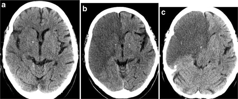 如何平稳度过脑水肿,多种原因导致的脑水肿首选是什么