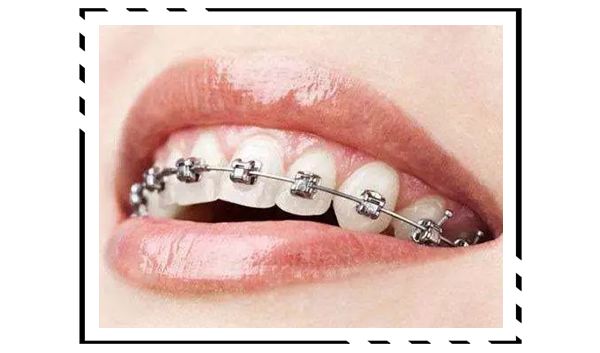 戴牙套换粗钢丝,拔四颗牙戴牙套的脸型变化图