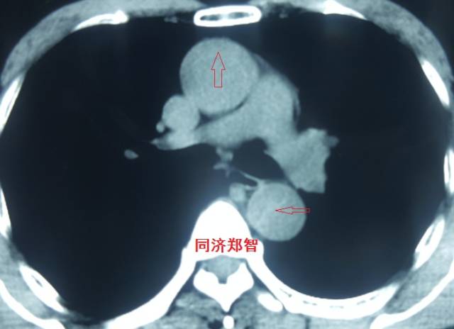 没有cta这三招也能识别主动脉夹层,磁共振可以替代cta检查主动脉夹层