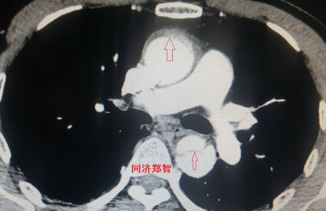 没有cta这三招也能识别主动脉夹层,磁共振可以替代cta检查主动脉夹层