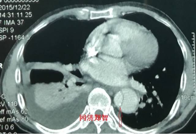 没有cta这三招也能识别主动脉夹层,磁共振可以替代cta检查主动脉夹层