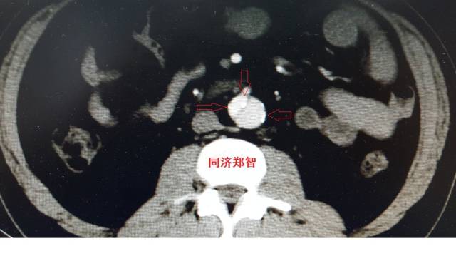 没有cta这三招也能识别主动脉夹层,磁共振可以替代cta检查主动脉夹层