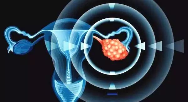 巧克力囊肿会引起ca199升高吗,巧克力囊肿是什么