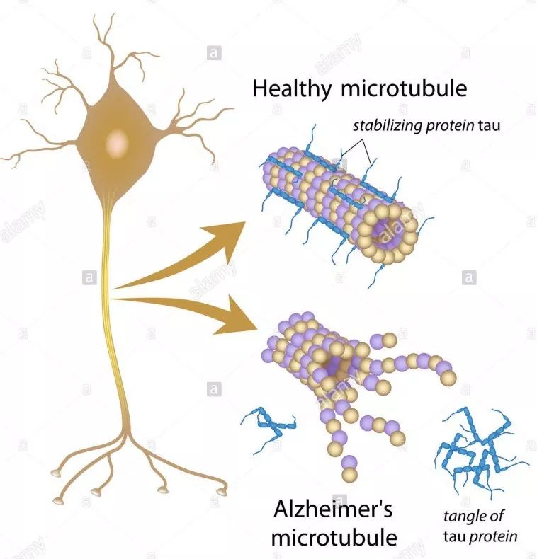 tau蛋白如何检查,tau蛋白病怎么干预