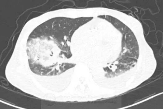 肺空洞性疾病的鉴别,肺空洞多见于哪些疾病