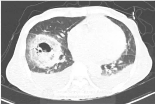 肺空洞性疾病的鉴别,肺空洞多见于哪些疾病