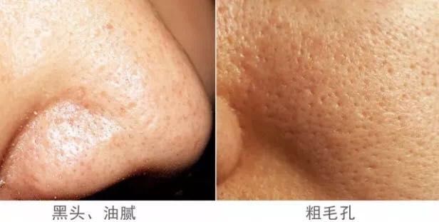 痘痘黑头清理方法,彻底解决痘痘黑头