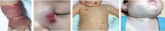 孩子脸上红色胎记什么原因引起,孩子脸上红棕色的胎记