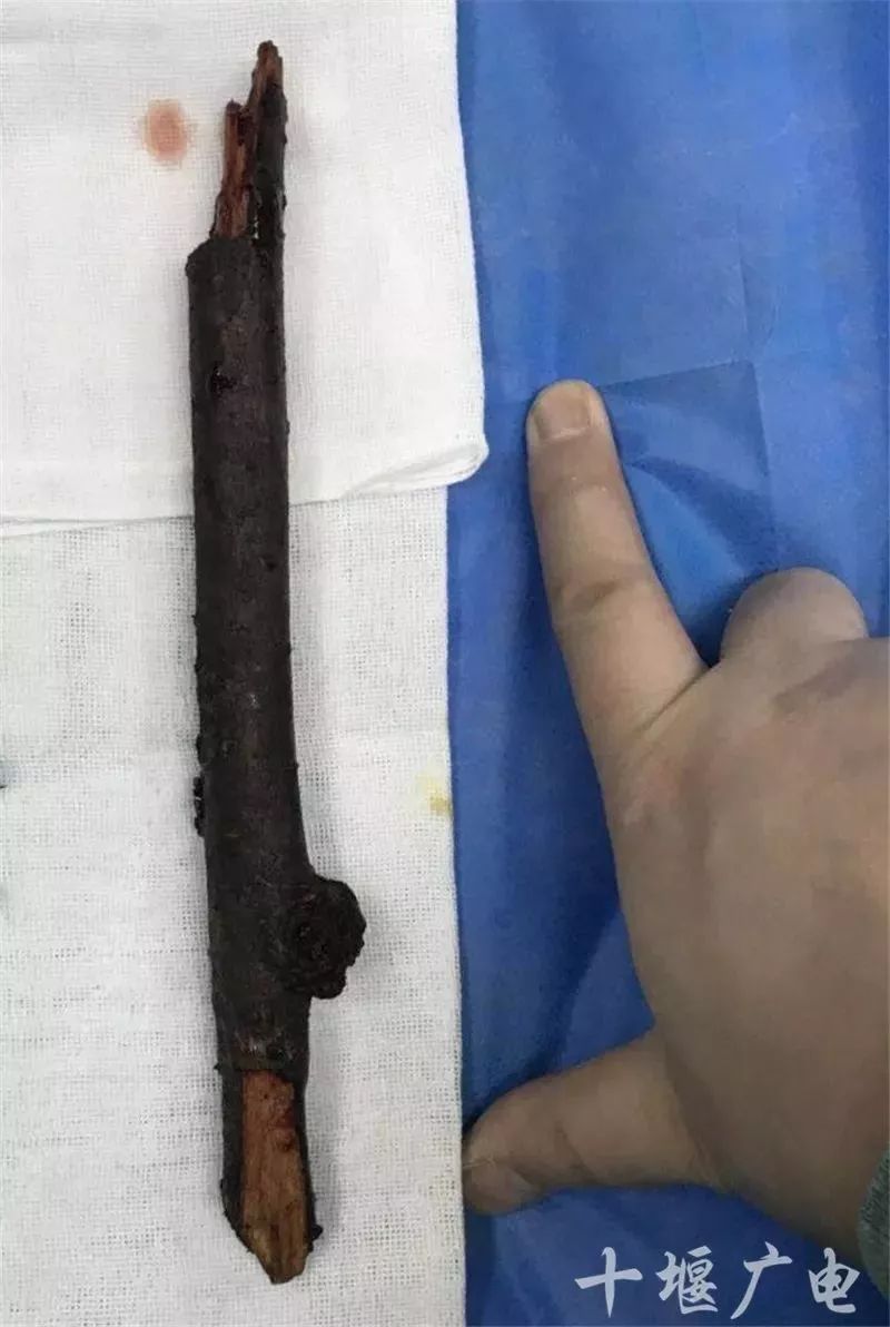 十堰女子骑在树上摘樱桃，结果子宫被切除！还从腹腔取出了...