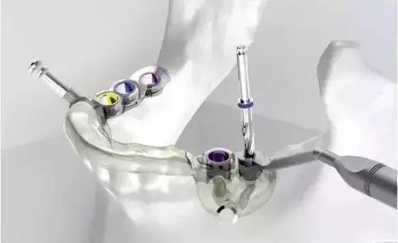 全新数字化种牙技术,3d导板种植牙新技术