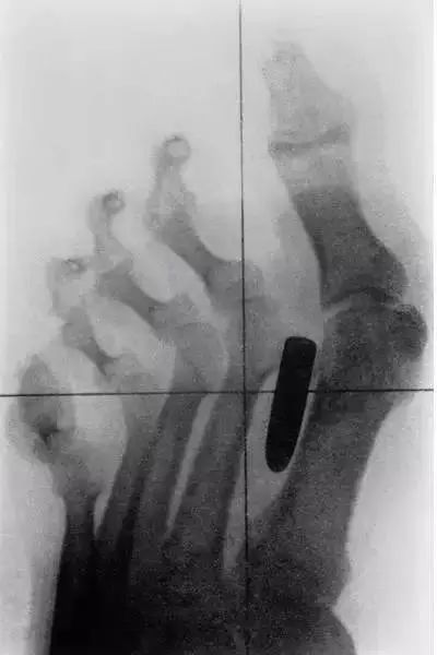 16张非常恐怖的X光照片