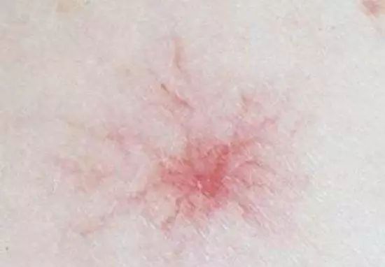 痣是肝癌的早期信号吗,肝癌身上出现红痣图片提示