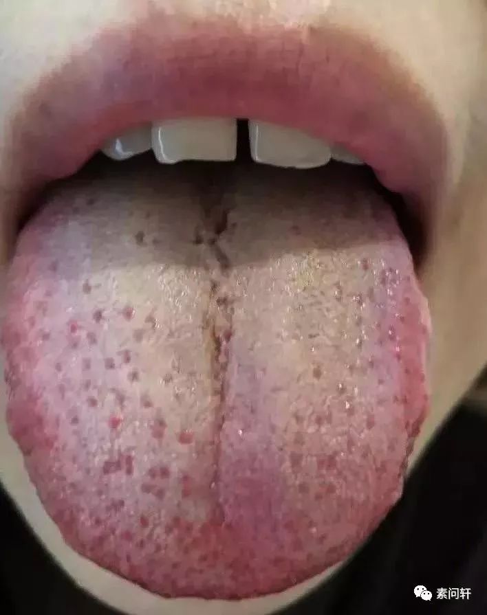 如何判断湿热还是湿寒体质,怎么判断是湿热体质