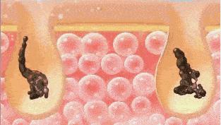 严重的黑头怎么处理教程,反复黑头的原因和解决方法