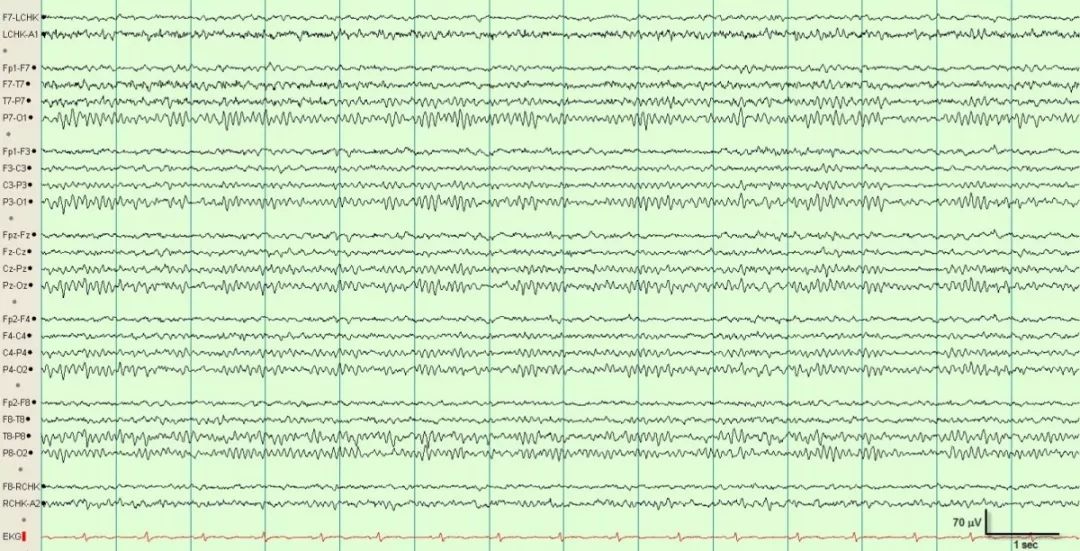 正常脑电图报告单图片,正常脑电图检查报告单第一页