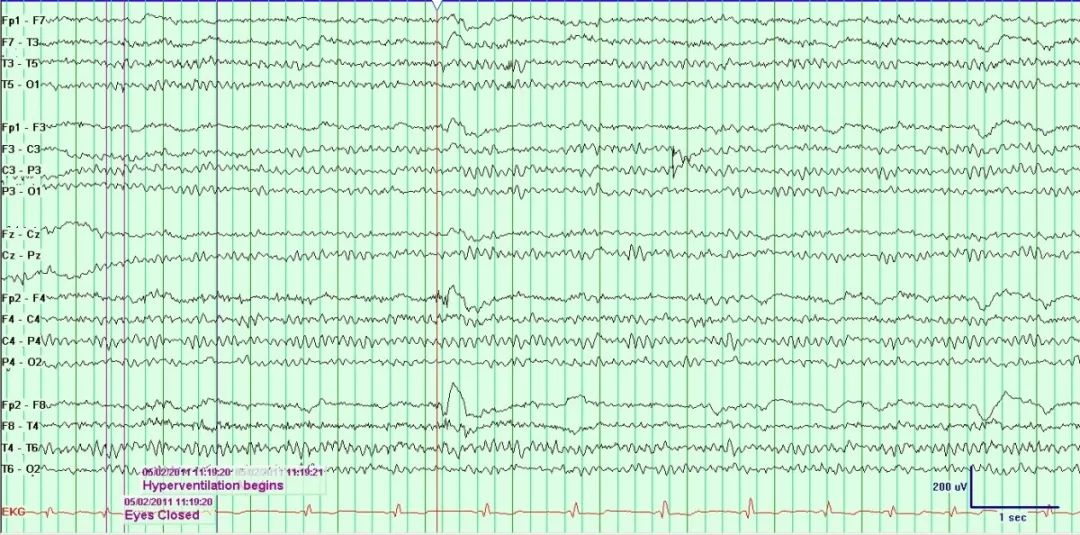 正常脑电图报告单图片,正常脑电图检查报告单第一页