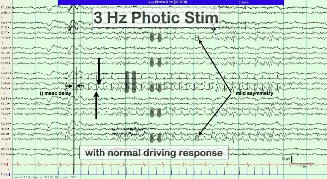 正常脑电图报告单图片,正常脑电图检查报告单第一页