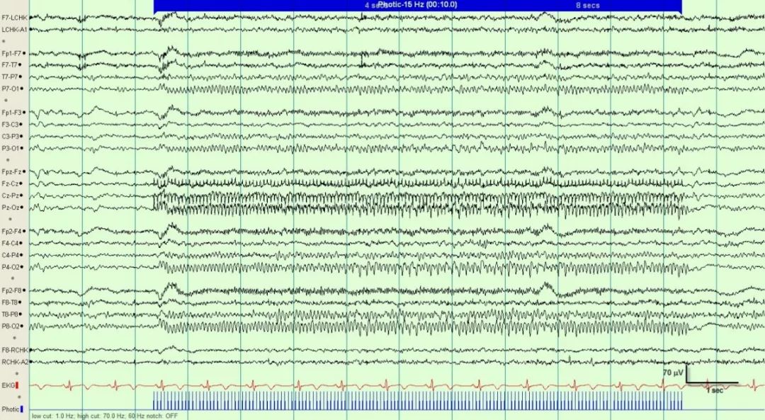正常脑电图报告单图片,正常脑电图检查报告单第一页