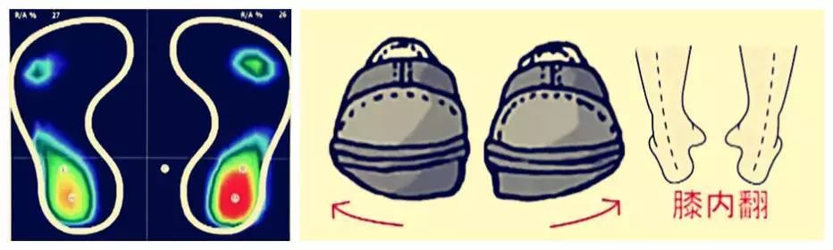 图解鞋底磨损4大类型,一个月鞋底就磨损是不是质量问题