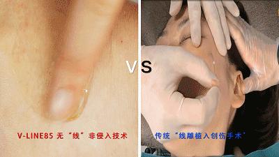 抬头纹法令纹鱼尾纹克星能管用吗,抬头纹鱼尾纹法令纹均可改善