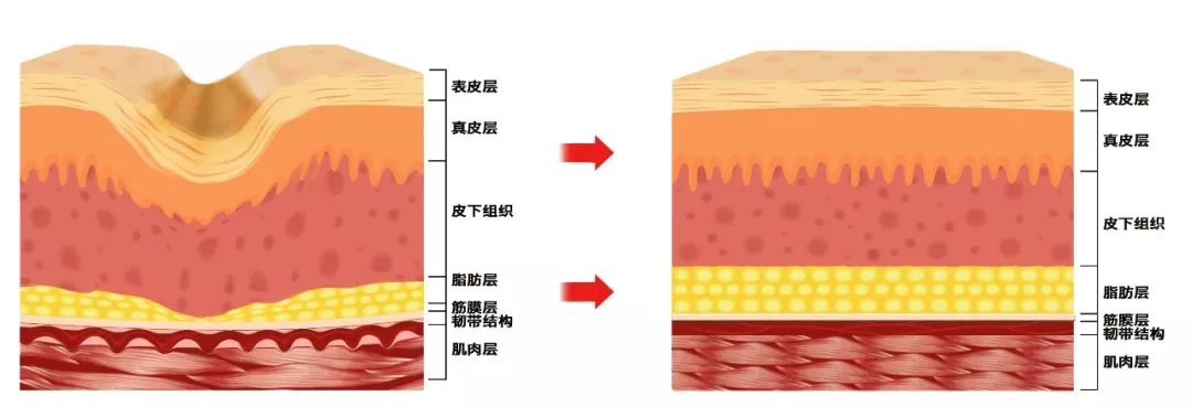 抬头纹法令纹鱼尾纹克星能管用吗,抬头纹鱼尾纹法令纹均可改善