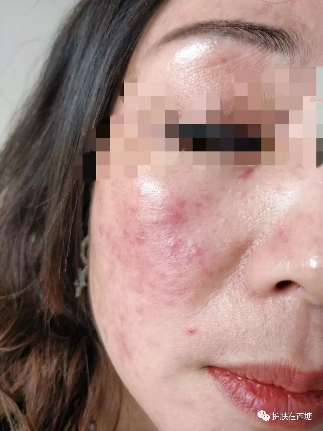 激素依赖性皮炎怎么才能彻底治好,激素依赖性皮炎好了以后怎么护肤