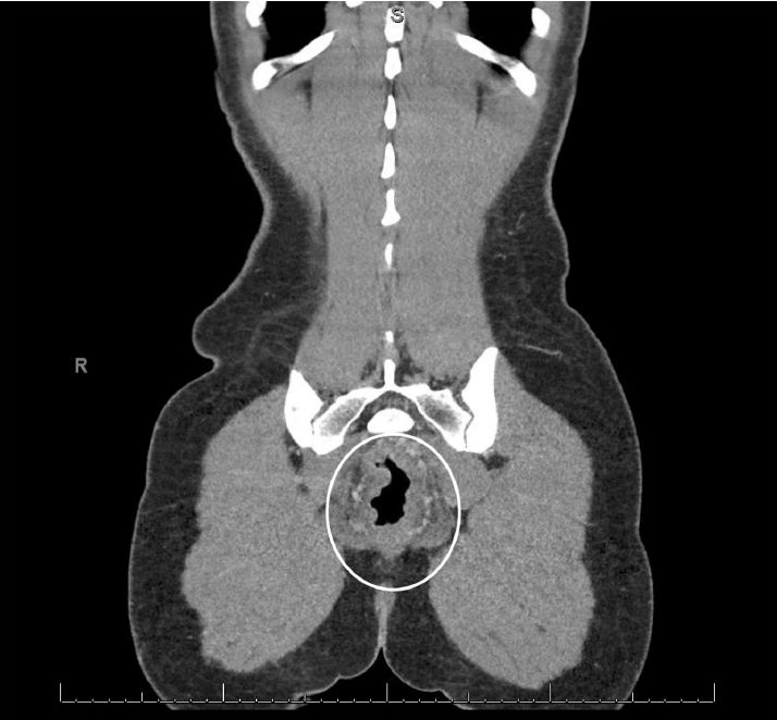 病例分享|一键保存！年轻女性因直肠疼痛而无法坐下？
