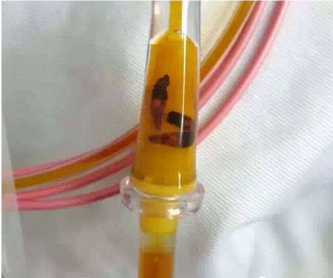 吃完这种菜，男子突然眼珠发黄，尿色如豆油！很多食物能吃出这个病，夏天千万注意...