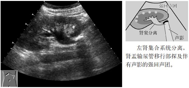 肾结石图片输尿管结石症状,输尿管上段结石超声碎石危害大么