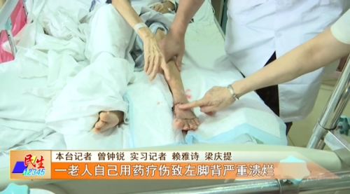 一老人自己用药疗伤致左脚背严重溃烂