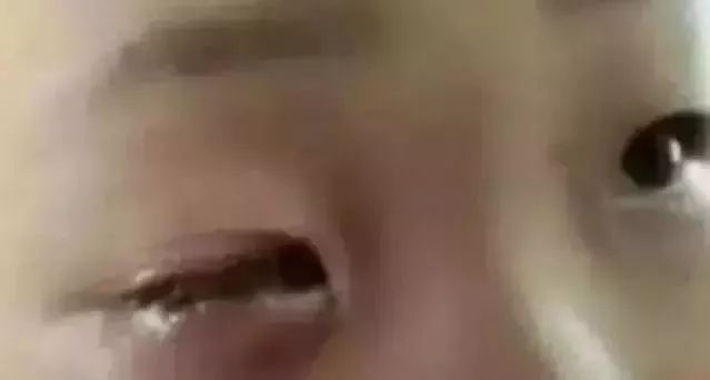 7岁男孩眼球被炸后融化,男童眼球瞬间被融化
