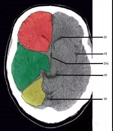 颅脑影像读片教程,颅脑影像读片怎么看