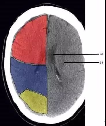 颅脑影像读片教程,颅脑影像读片怎么看