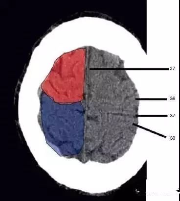 颅脑影像读片教程,颅脑影像读片怎么看