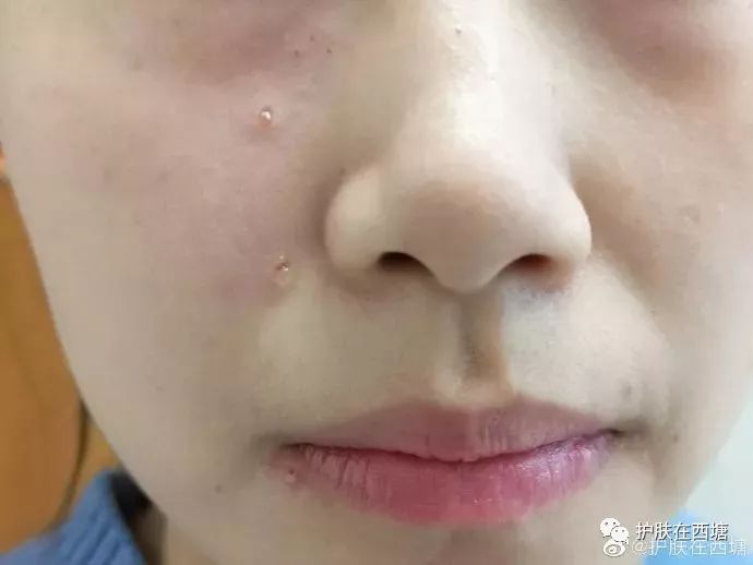 内痔的最快消除方法,去脸上的痣用哪种方法最好