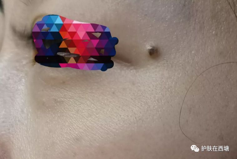 内痔的最快消除方法,去脸上的痣用哪种方法最好