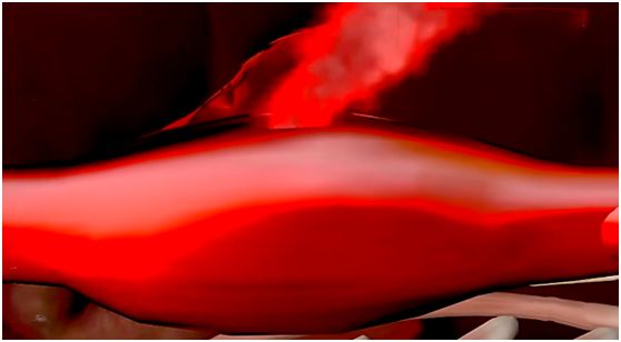 过量服用阿司匹林有什么危害,阿司匹林误吃超量怎么办