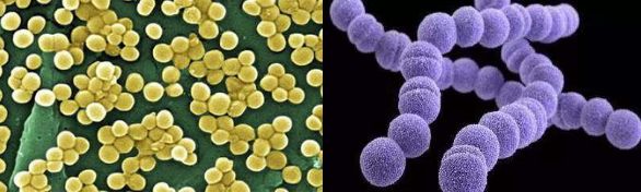 孩子流黄脓鼻涕是怎么引起的,儿童脓疱疮流黄水