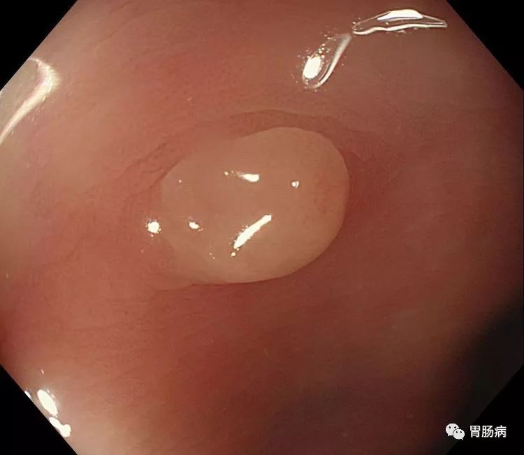 消化息肉科普视频,结直肠息肉癌变的规律