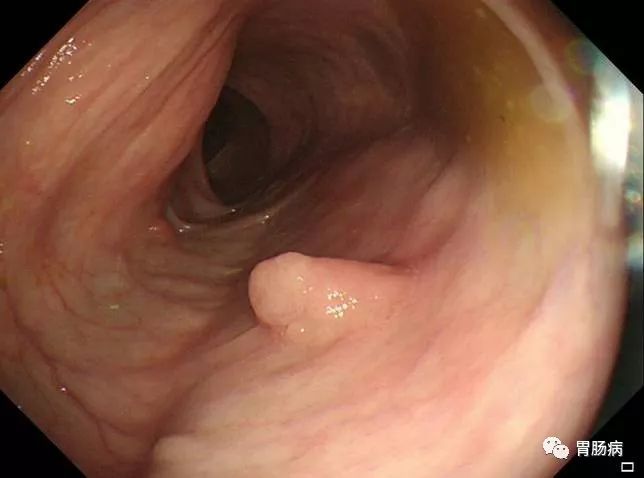 消化息肉科普视频,结直肠息肉癌变的规律