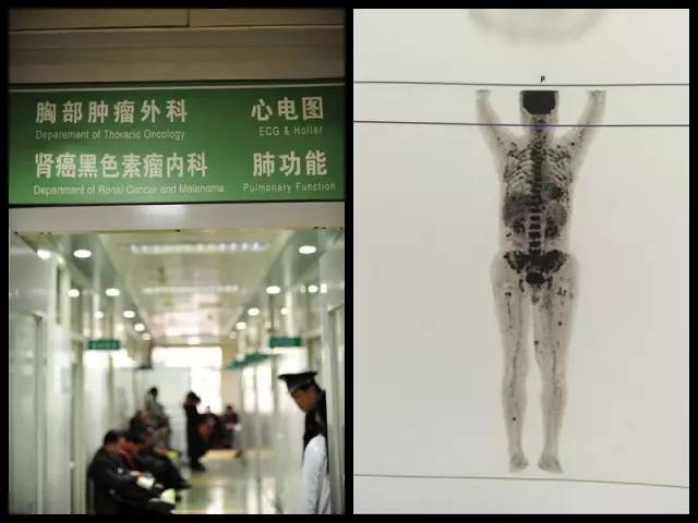 哪个部位的痣会有癌变风险,身体上已有的痣容易癌变吗