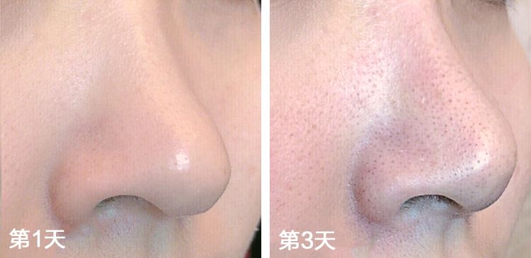 怎样高效快速去黑头,如何快速高效的去黑头